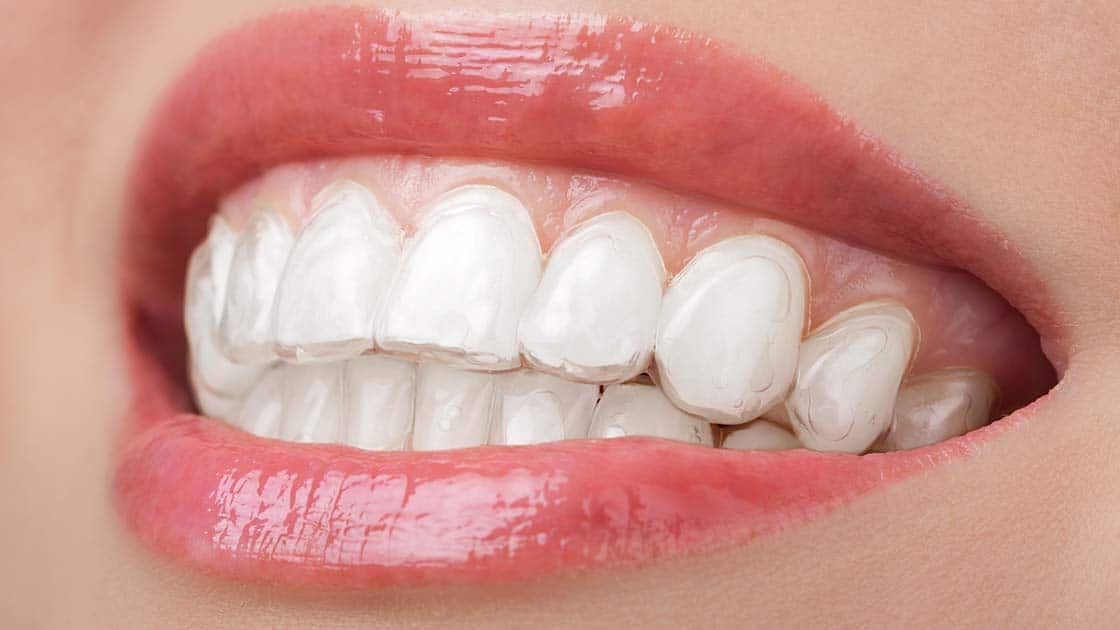 Clear aligners