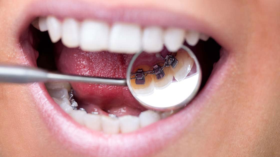 Lingual braces