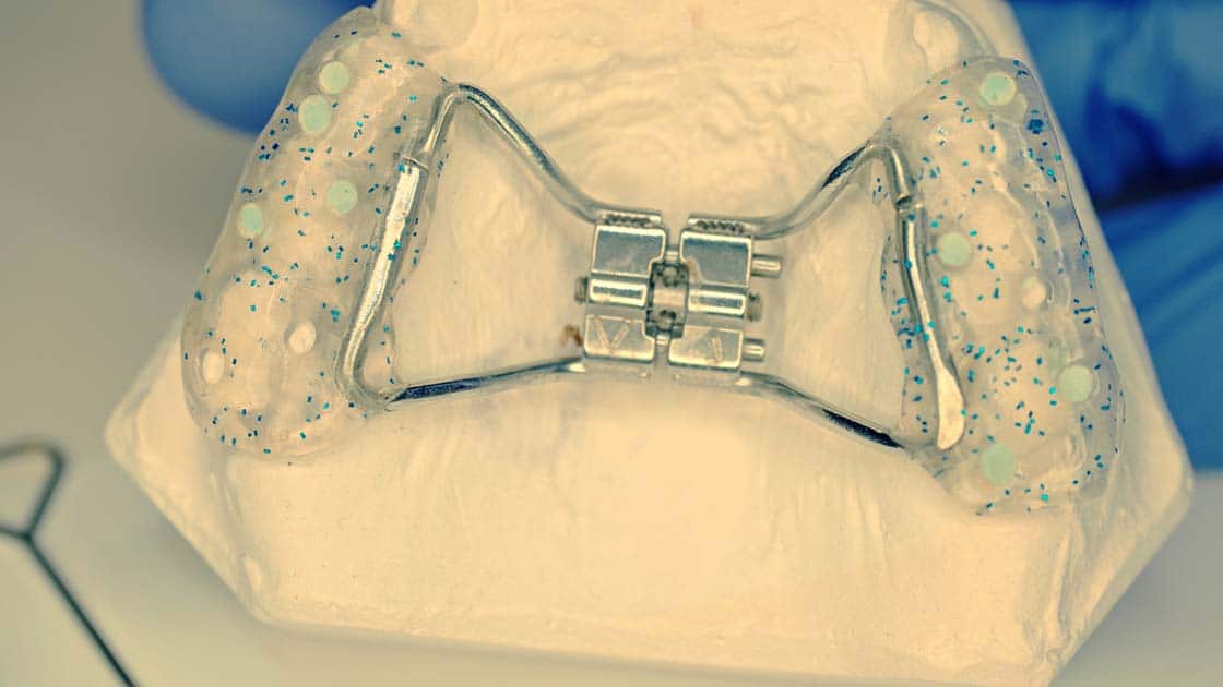 Palatal expanders on clay models