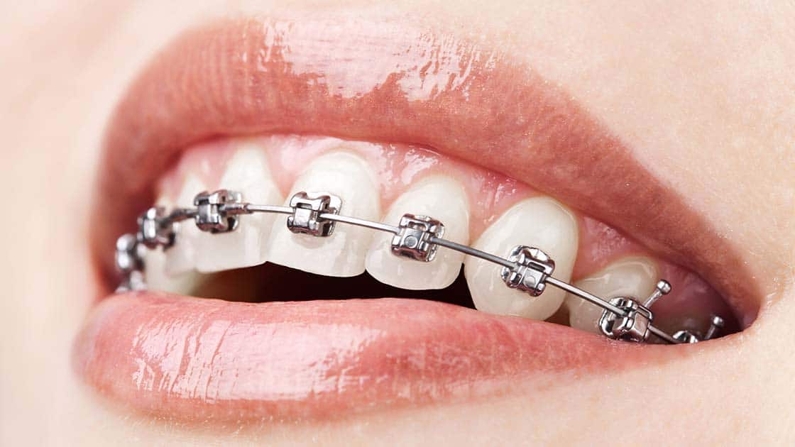 Self-ligating braces